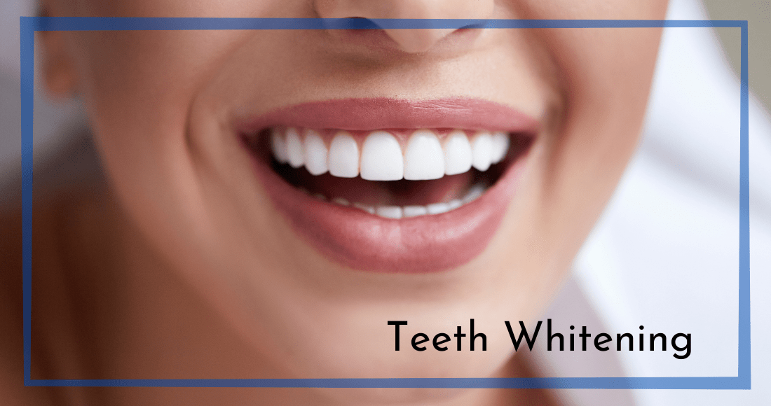 Teeth Whitening Chesapeake VA - Chesapeake Virginia Dentist