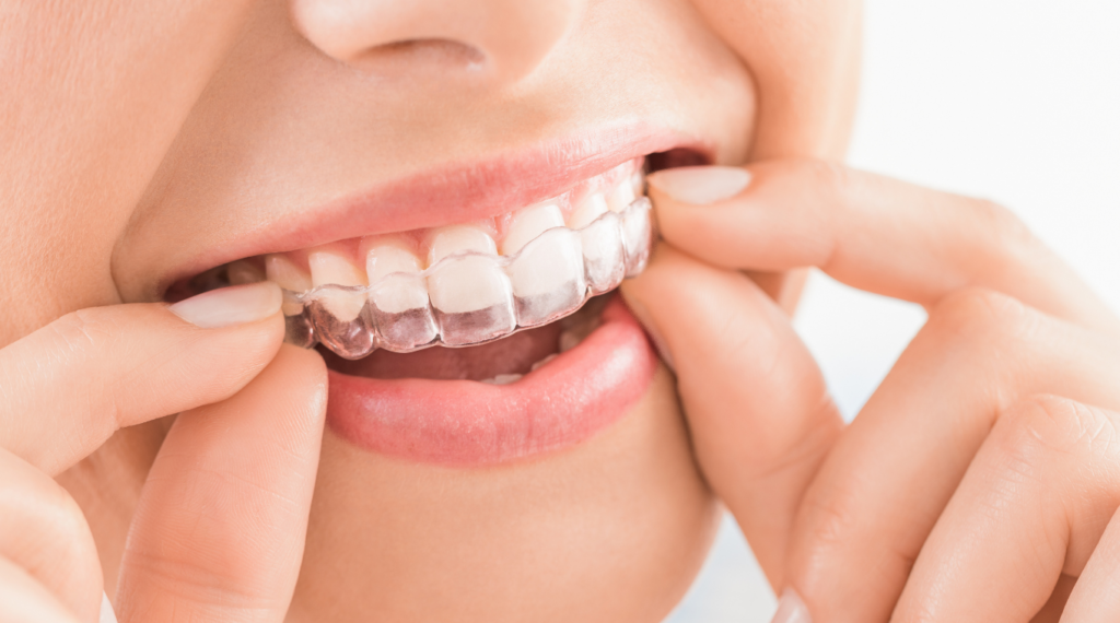 Chesapeake_Invisalign®_dentist