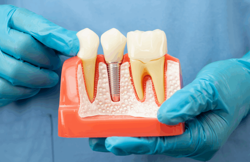dental_implants_Chesapeake_dentist